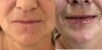 55-64 year old woman treated with Lip Fillers