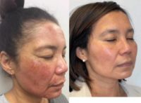 Woman treated with Laser Resurfacing