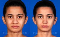 25-34 year old woman treated with Rhinoplasty