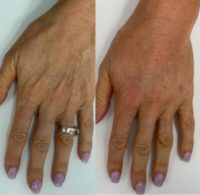 45-54 year old woman treated with Hand Rejuvenation