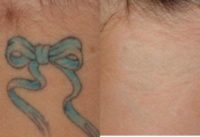 Laser tattoo removal