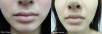 18-24 year old woman treated with Lip Lift
