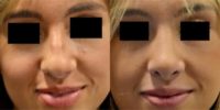 18-24 year old woman treated with Rhinoplasty