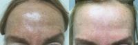 35-44 year old woman treated with Melasma Treatment