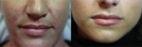 25-34 year old woman treated with Injectable Fillers to naturally enhance lips