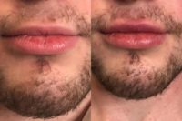 18-24 year old man treated with Restylane Silk