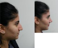 18-24 year old woman treated with Rhinoplasty