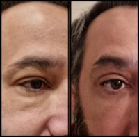 45-54 year old man treated with Double Eyelid Surgery