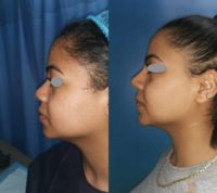 18-24 year old woman treated with African American Rhinoplasty