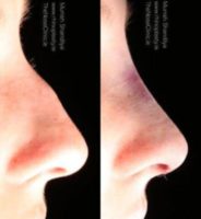 18-24 year old woman treated with Rhinoplasty