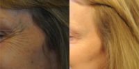 45-54 year old woman treated with Botox