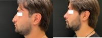 25-34 year old man treated with Rhinoplasty