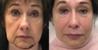 65-74 year old woman treated with Juvederm