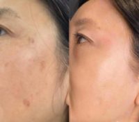 Woman treated with Facial