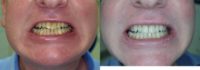 45-54 year old man treated with Porcelain Veneers