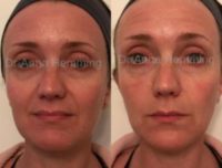 35-44 year old woman treated with Injectable Fillers