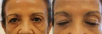 65-74 year old woman treated with Restylane