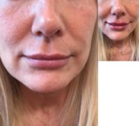 35-44 year old woman treated with Juvederm Ultra in the Lips