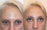 31 year old woman treated with Juvederm Volbella Under the Eyes