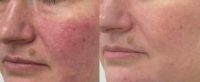 45-54 year old woman treated with Skin Rejuvenation, SkinCeuticals, Skin Lightening