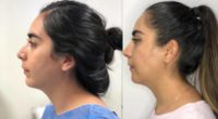 18-24 year old woman treated with Chin Surgery