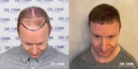 45-54 year old man treated with FUE Hair Transplant