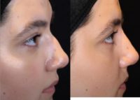 18-24 year old woman treated with Nonsurgical Nose Job
