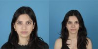 18-24 year old woman treated with Rhinoplasty