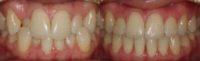 Invisalign Clear Braces