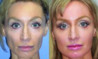 35-44 year old woman treated with Botox