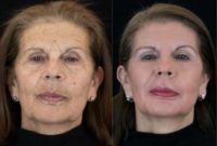 65-74 year old woman treated with Facelift