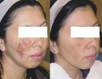 43 year old woman treated with Pico Laser for Hyperpigmentation