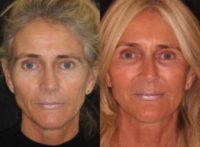 45-54 year old woman treated with Liquid Facelift