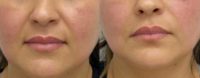 25-34 year old woman treated with Dermal Fillers, Restylane