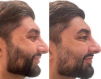 Man treated with Botox