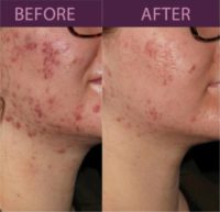 18-24 year old woman treated with Accutane