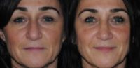 45-54 year old woman treated with Rhinoplasty