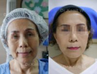 55-64 year old woman treated with Facelift