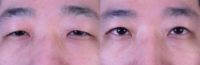 35-44 year old man treated with Double Eyelid Surgery and Eyelid Ptosis Correction