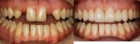 25-34 year old woman treated with Smile Makeover