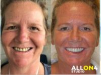55-64 year old woman treated with All-on-4 Dental Implants