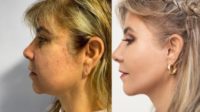 45-54 year old woman treated with SMAS Facelift