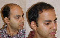 35-44 year old man treated with Hair Transplant