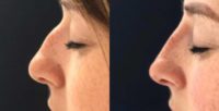 25-34 year old woman treated with Nonsurgical Nose Job