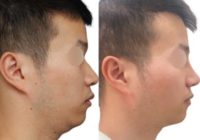 25-34 year old man treated with Asian Rhinoplasty, Rhinoplasty