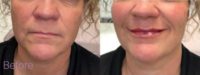 Woman treated with Lip Fillers