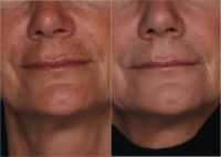 55-64 year old woman treated with Fraxel Laser