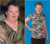 Female Gastric Bypass Patient Lost 124 lb