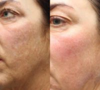 45-54 year old woman treated with Microneedling