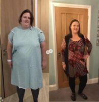 Woman treated with Gastric Sleeve Surgery